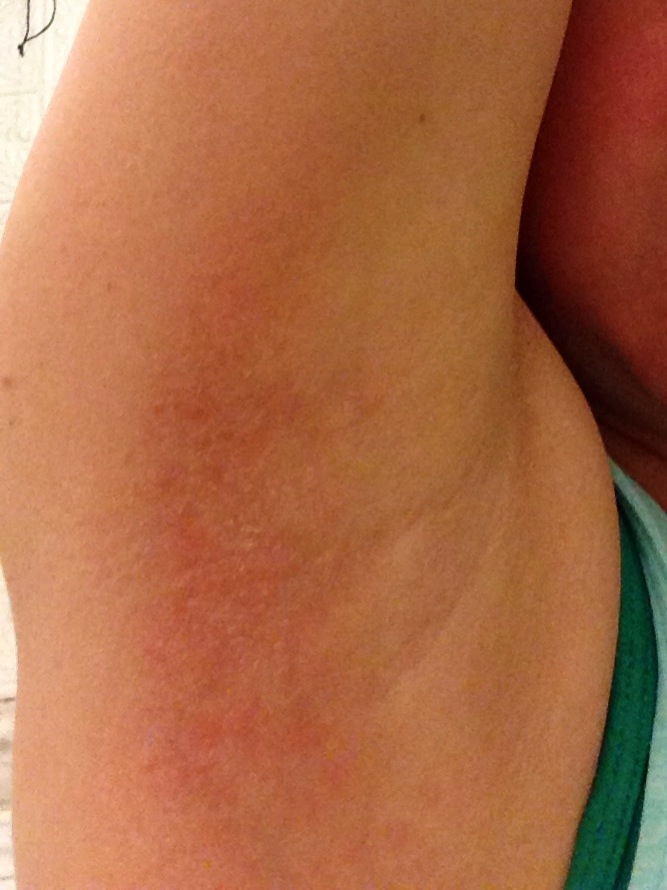 allergic reaction